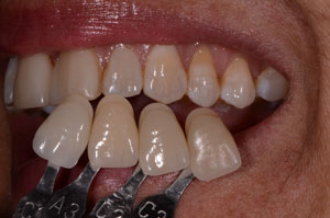 Custom Shade Matching