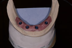 Dental Implants