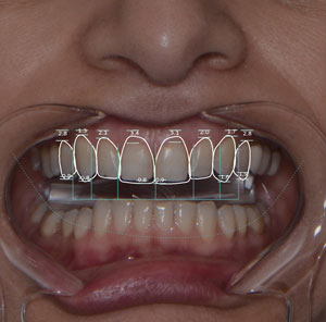 Digital Smile Design